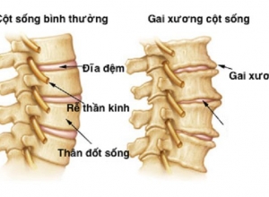 Tổng Quan Bệnh Gai Cột Sống - Nguyên Nhân, Triệu Chứng Và Cách Phòng Ngừa